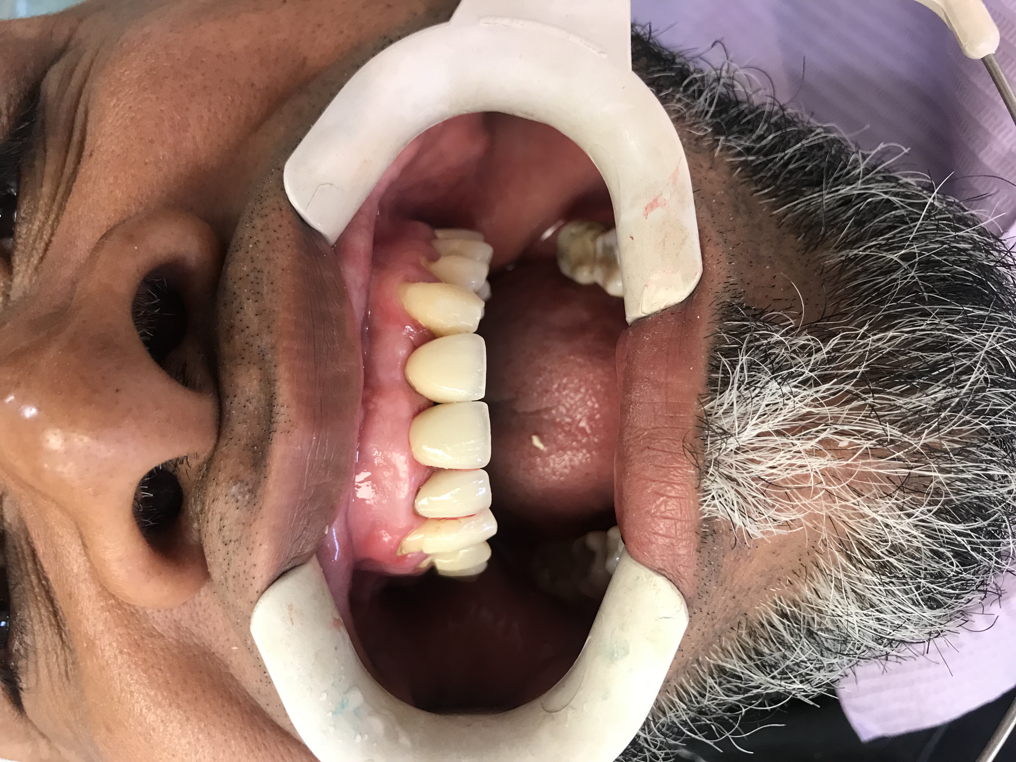 Vista de cerca de los dientes frontales superiores restaurados