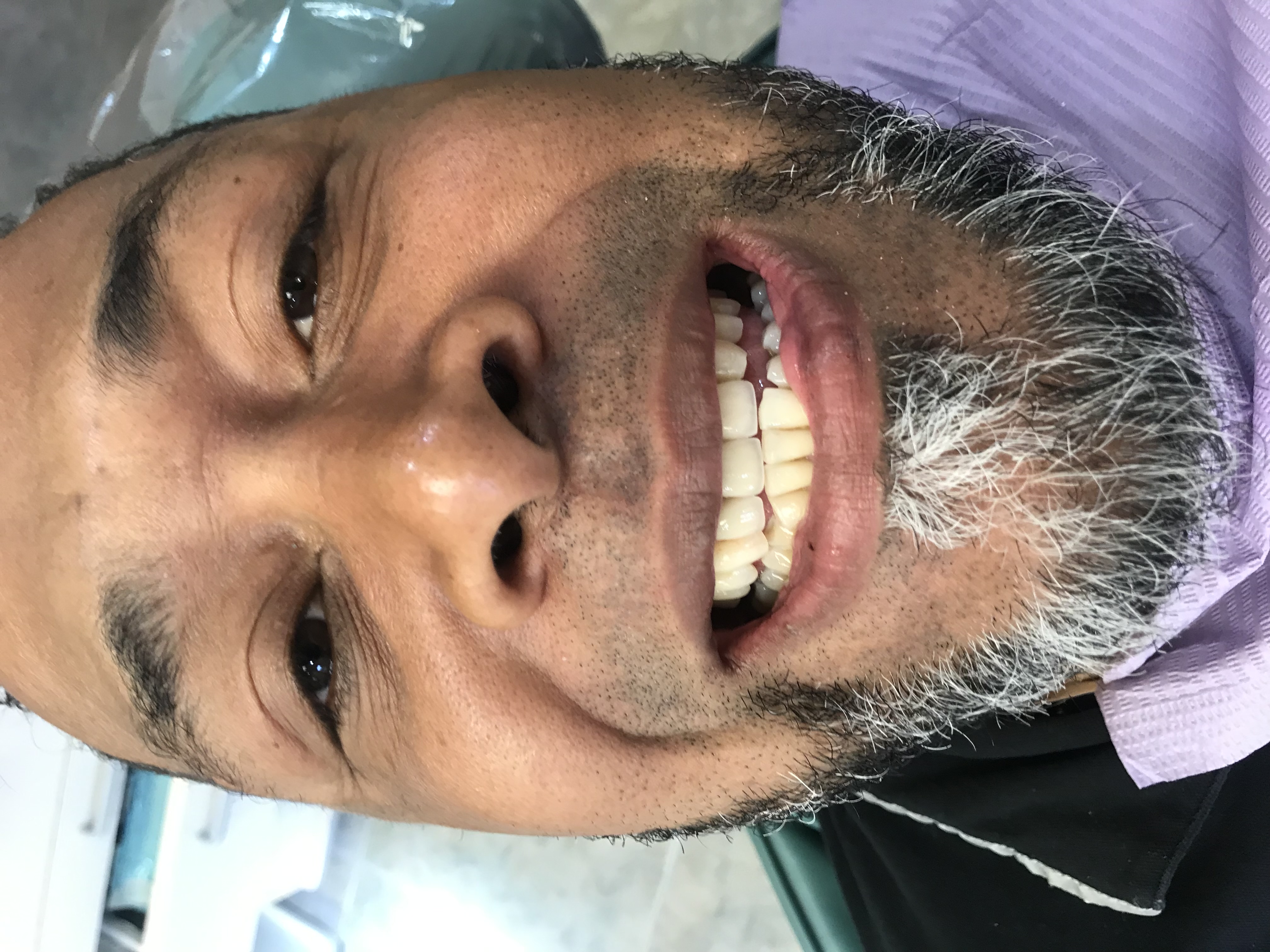 El paciente sonriendo después de la restauración de sus dientes frontales