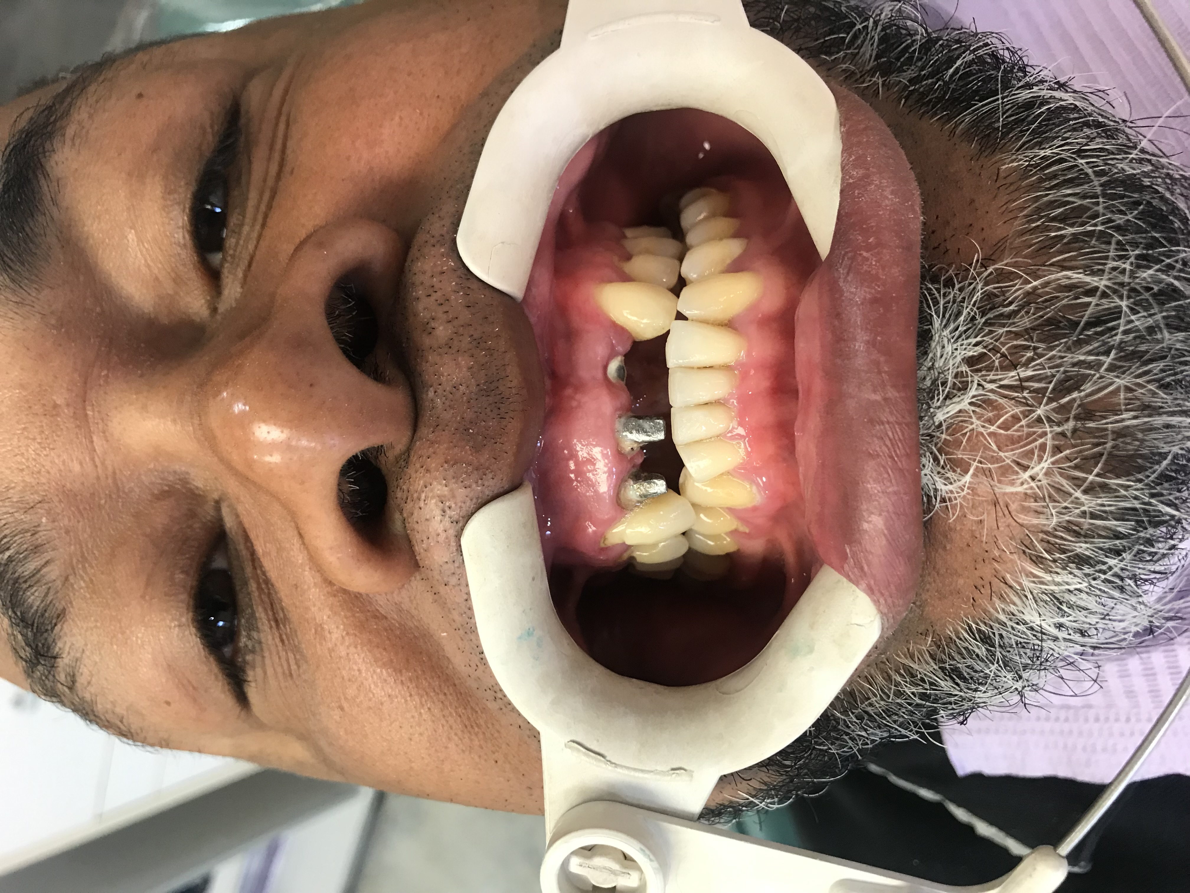 Vista de los dientes frontales superiores antes de la restauración final